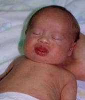 Infant with Down syndrome. Note up-slanting palpeb Infant with Down syndrome
