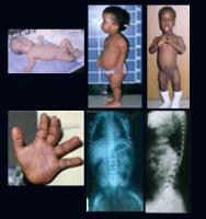 pseudoachondroplasia radiology