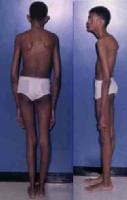 Adult with Marfan syndrome. Note tall and thin bui