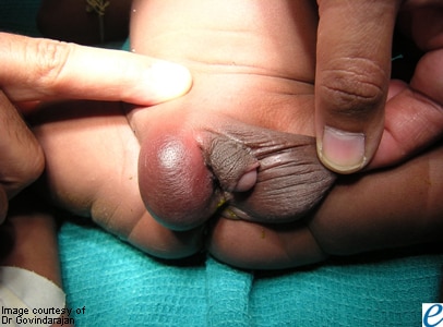 Perinatal torsion.