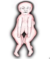 Conjoined Twins Conjoined Twins