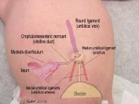 Umbilical Cord Granuloma