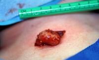 Lymph Node Disorders Treatment & Management