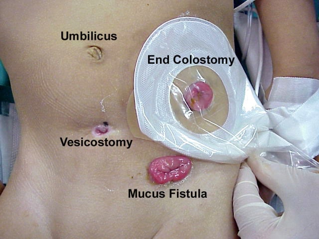 mucus in toddlers stool