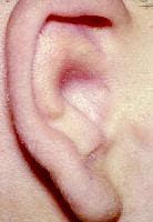 ear stenosis