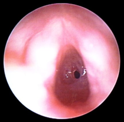  subglottic stenosis from intubation. Vocal cords are in the foreground.
