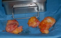Resected tissue. Note that the white tissue, which