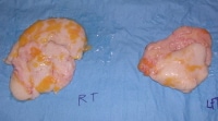 Resected gynecomastia tissue. Courtesy of Miguel D