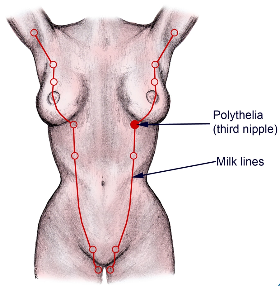 Breast hypertrophy - Wikipedia