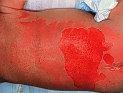 Burn wound cellulitis presents with increasing er...