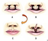 Bilateral Cleft Lip Repair: Background, History Of The Procedure, Problem