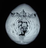 Mendosal Suture Ct