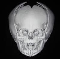 Mendosal Suture Ct