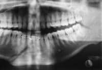 Mandibular Parasymphysis