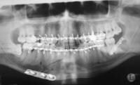 Tooth 17