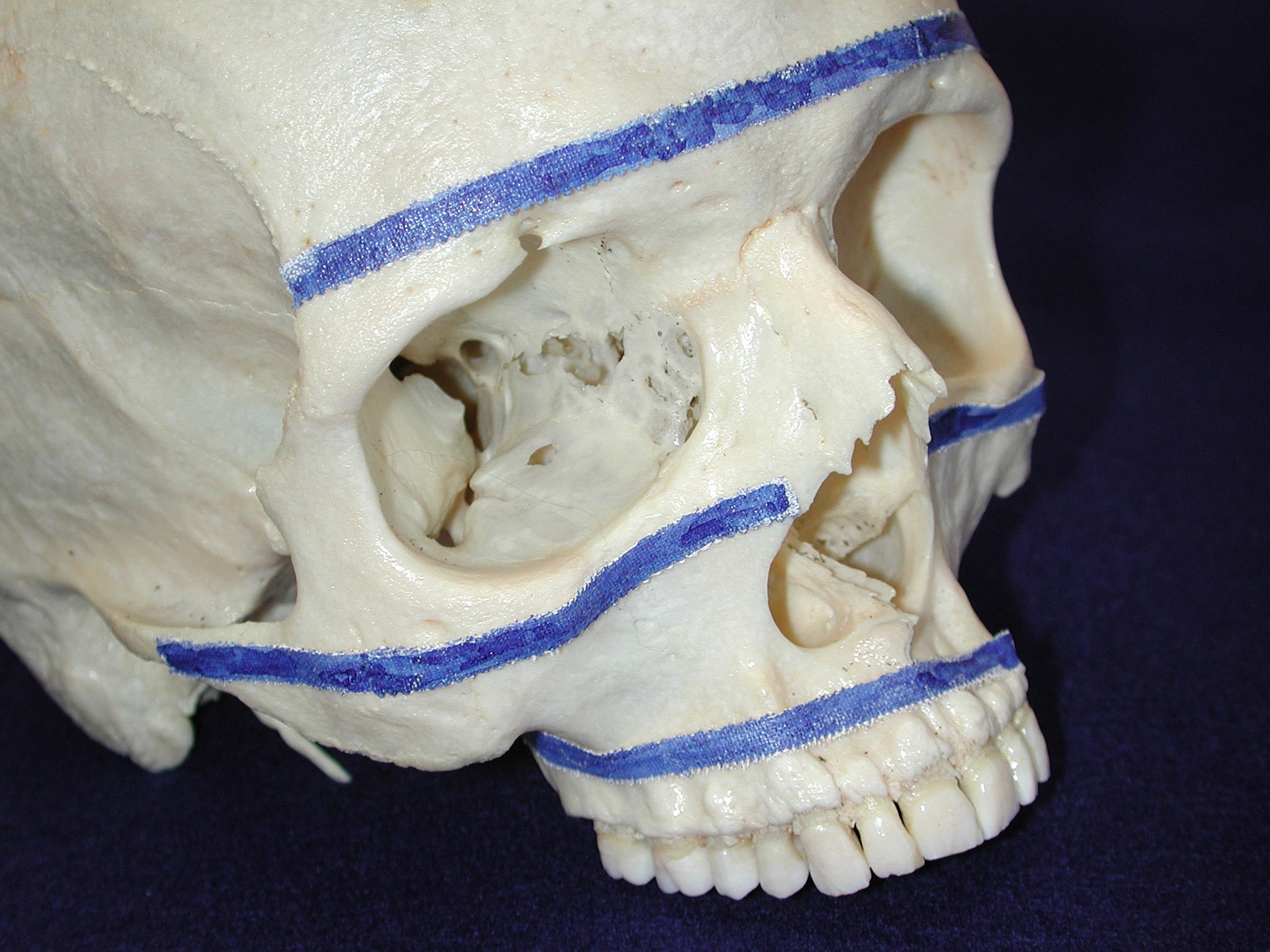 Horizontal buttresses of facial  skeleton.