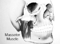 Anatomic depiction of the masseter muscle as it r...