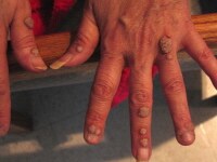 A more common name give to the condition of herpetic whitlow is finger herpes. Also known as hand herpes, or digital herpes simplex, this cutaneous infection is a form of skin infection that affects the fingers of a person. It is a viral infection th