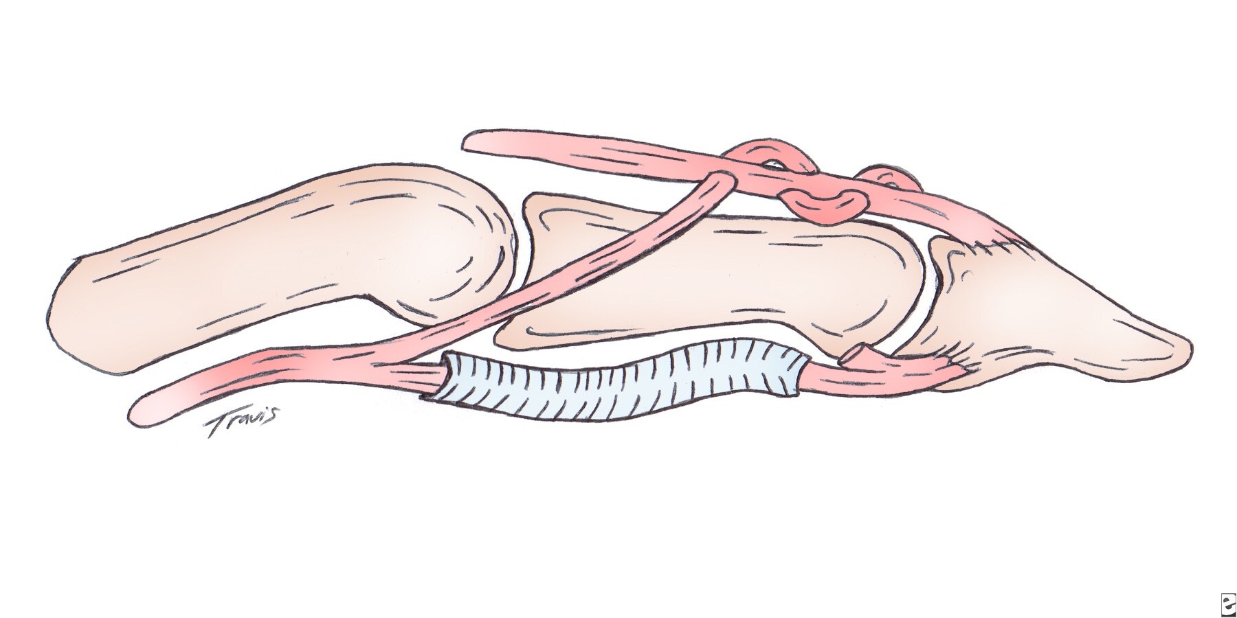 Extensor+Tendon+Repair+Protocol კომპლექტის ფასი 159 ლარი