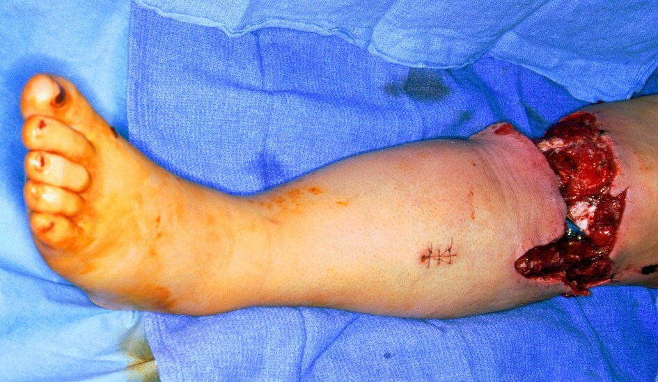 This photograph shows a complex degloving wound o...