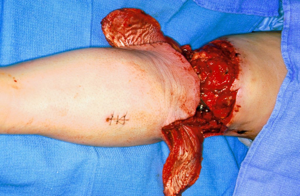 The medial (top) and lateral (bottom) gastrocnemi...