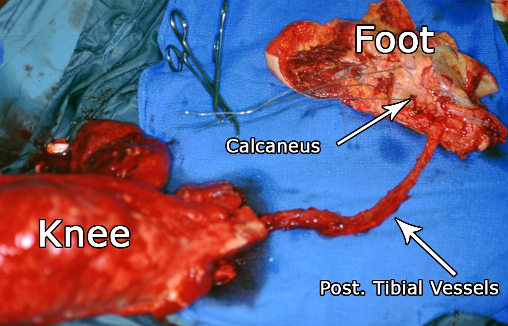 The foot has been isolated on the posterior tibia...