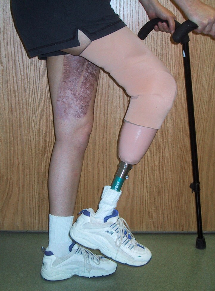 The good coverage allows for prosthesis fitting.