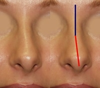 Rhinoplasty, Spreader Grafts