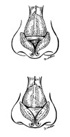 Diagram of spreader graft