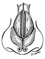 Diagram of spreader graft