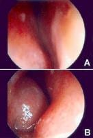 Inferior Nasal Turbinate