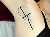 axillary hyperhidrosis