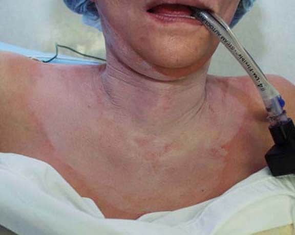 Patient following completion of the chemical peel.