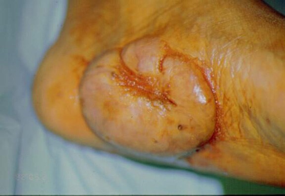 Keloid located on the foot. The initial injury wa.