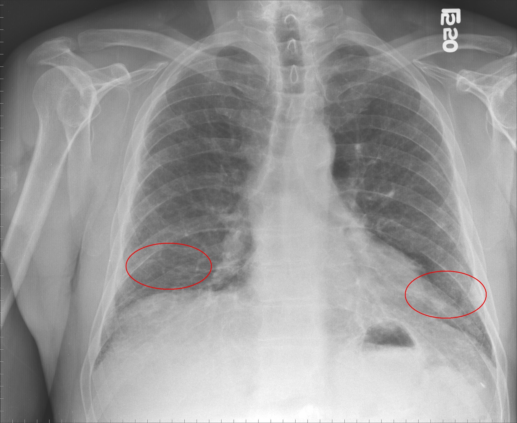 pulmonary-fibrosis-alveolitis-fibrosing-hamman-rich-syndrome