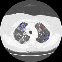 A patient with nonspecific interstitial pneumonia.
