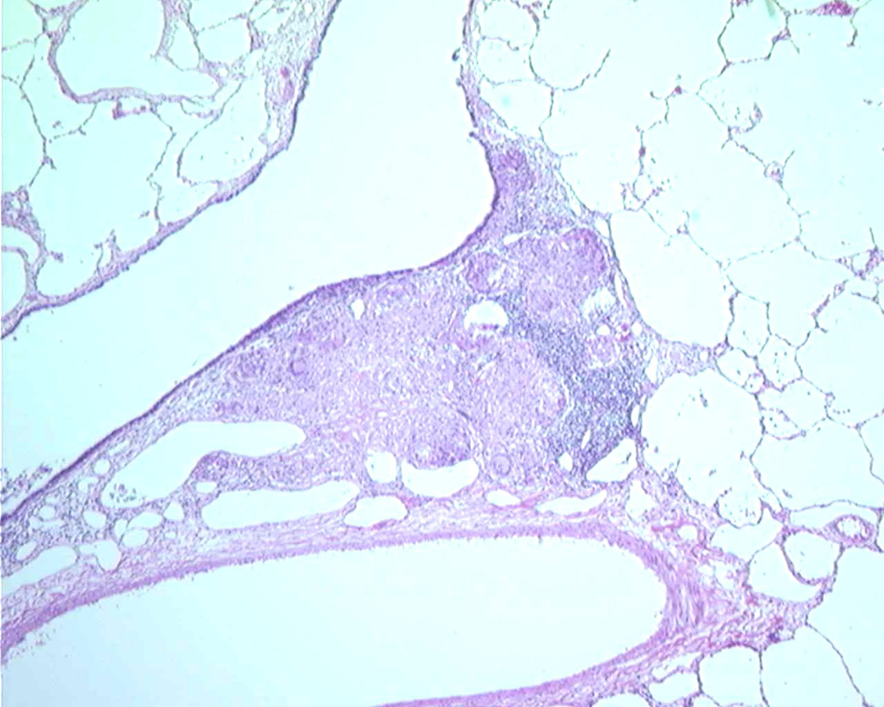 COLLAGEN VASCULAR DISEASE collagen vascular disease: