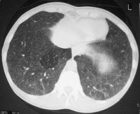 Ct Hypersensitivity Pneumonitis