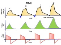 The pressure, volume, and flow to time waveforms ...