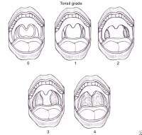 Tonsil Enlargement Grade