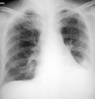 Aspiration pneumonia. An 84-year-old man in gener...