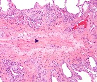 Capillary Disease