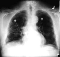 Asbestos pleural plaques. 