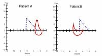 Flow volume curve of a patient with emphysema show