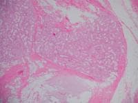 Histopathology of chronic bronchitis showing hyper