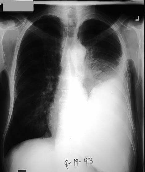 stage 4 adenoma pleural