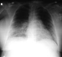 cmv pneumonia