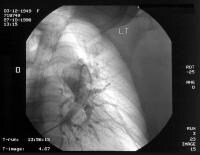 Left pulmonary arterial angiogram shows large cent