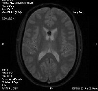 Central Neurocytoma