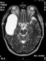 Axial T2-weighted MRI image through the midbrain,...